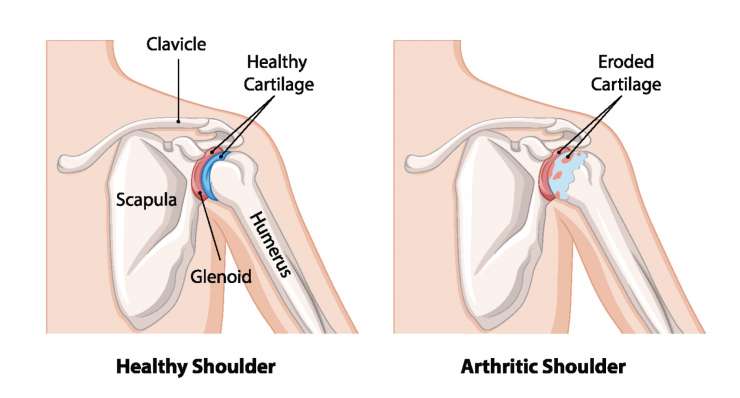 Arthrose ACG