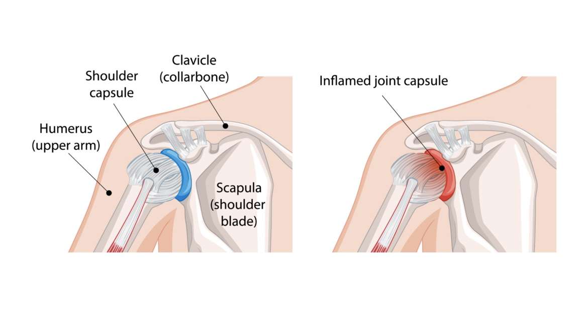 frozen-shoulder