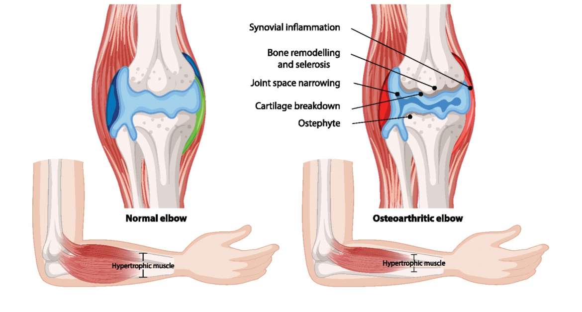 Ellenbogenarthrose