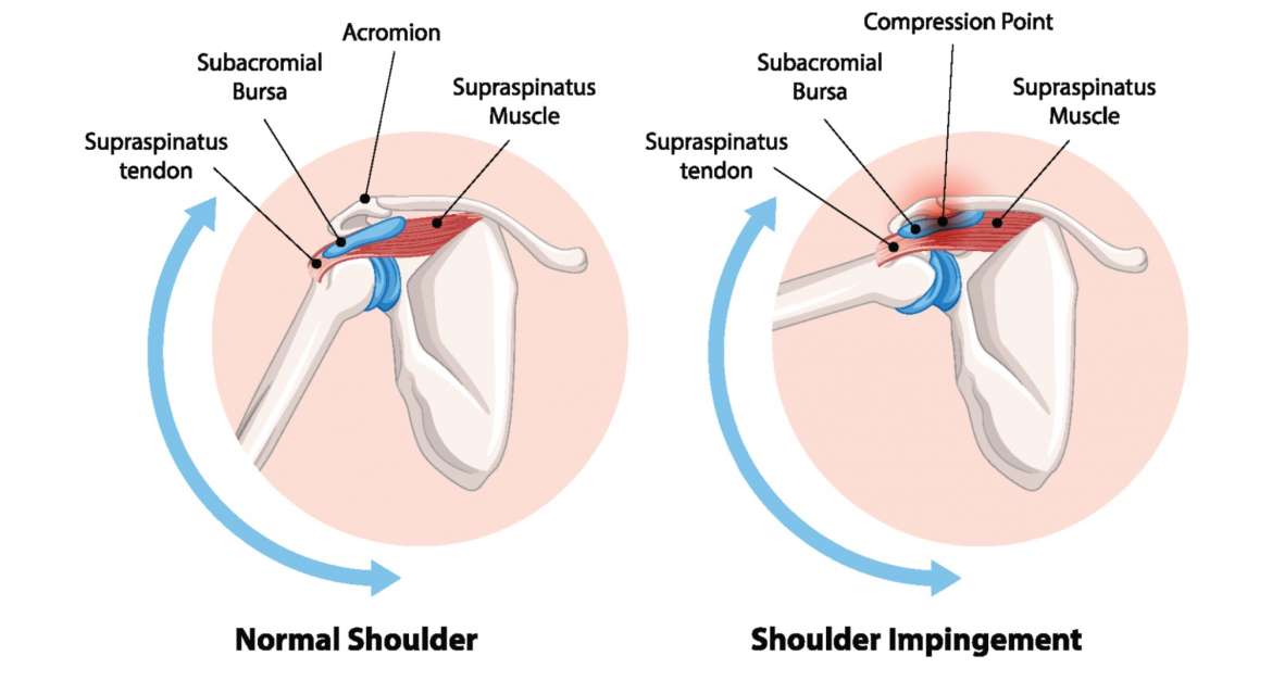 Subacromiales Impingement