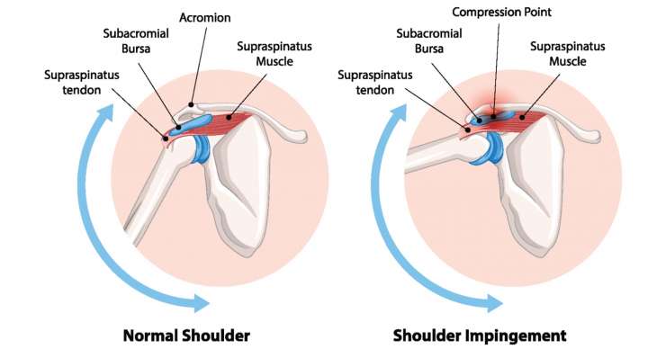 Subacromiales Impingement