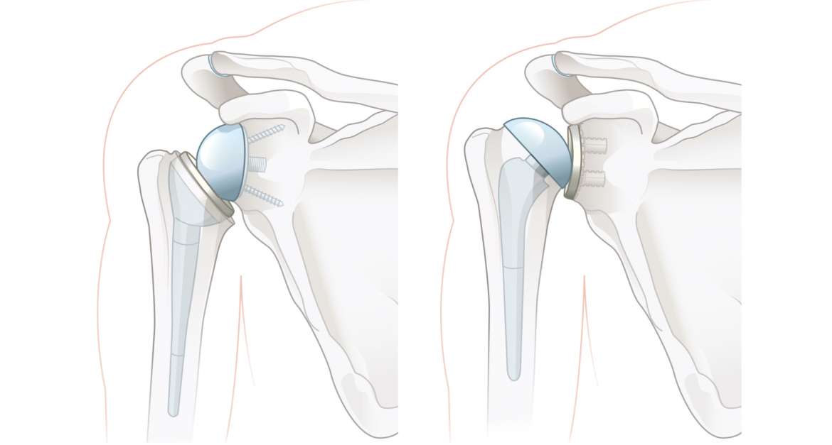 Schulterarthrose (Ormarthrose)