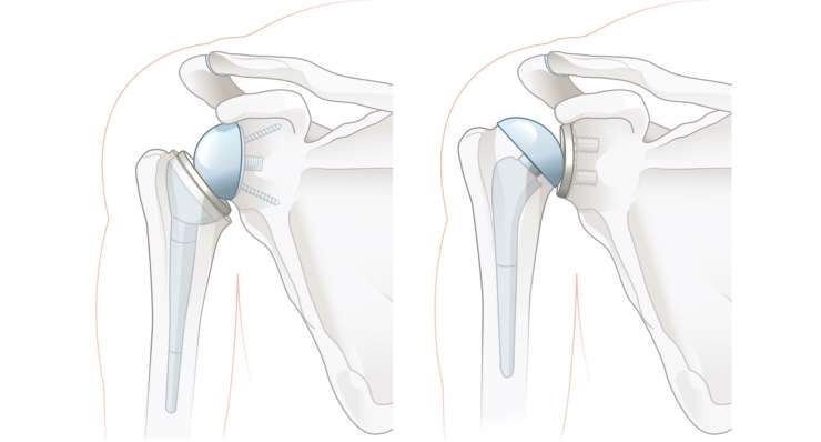 Schulterarthrose (Ormarthrose)