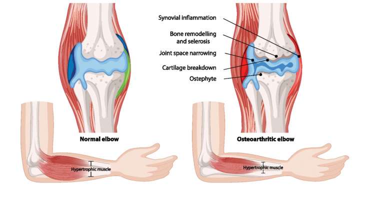 Ellenbogenarthrose - Verschleiß des Gelenkknorpels. Behandlung in München durch Prof. Dr. med. Martetschläger
