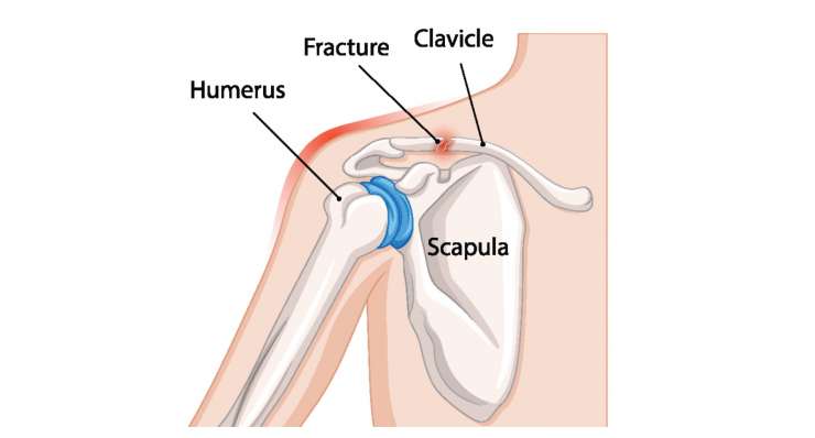 Fraktur des Schultergürtels. Behandlung in München durch Prof. Dr. med. Martetschläger