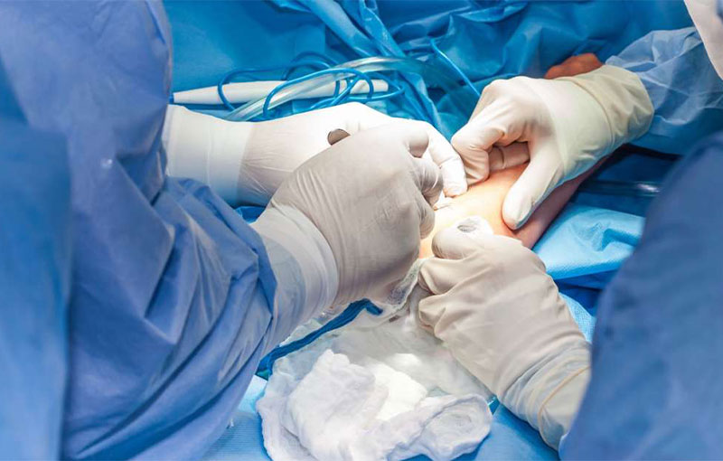 Offene Eingriffe am Ellenbogen in München - Durchgeführt von Prof. Dr. med. Martetschläger