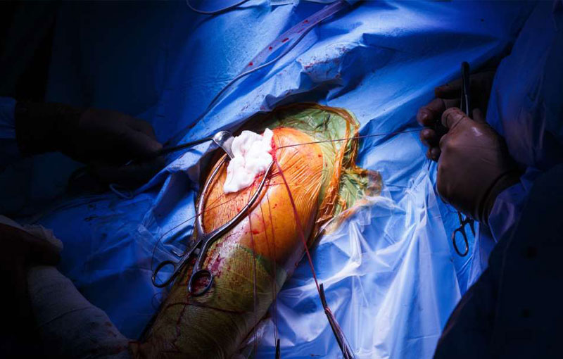 Offene und minimalinvasive Operationen an der Schulter in München - Durchgeführt von Prof. Dr. med. Martetschläger