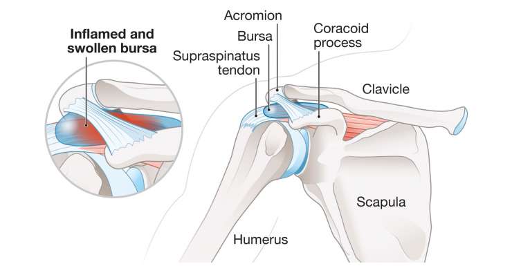 Schleimbeutelentzündung in der Schulter. Behandlung in München durch Prof. Dr. med. Martetschläger
