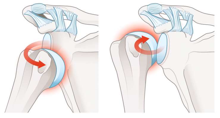 Schulterluxation - Auskugeln des Oberarmkopfes aus der Gelenkpfanne. Behandlung in München durch Prof. Dr. med. Martetschläger
